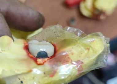 Dental alloys are not applicable Dental alloys are not applicable